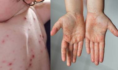 குழந்தைகளை தாக்கும் தக்காளி காய்ச்சல்